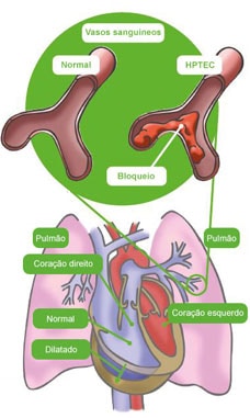 Como uma EP aguda leva à HPTEC?