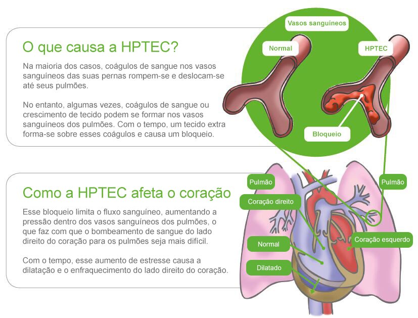 EP Aguda hptec maior